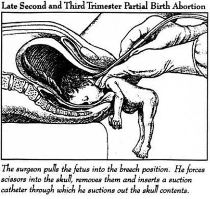 делать ли аборт